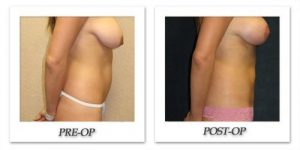 liposuction