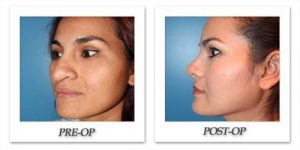 rhinoplasty