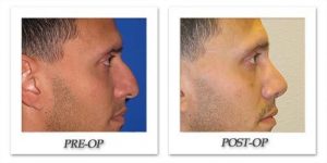 rhinoplasty