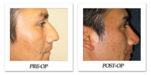 rhinoplasty