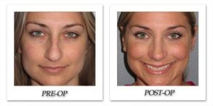 rhinoplasty