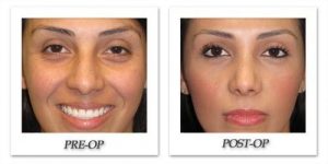 rhinoplasty