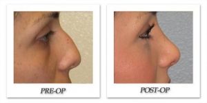 rhinoplasty