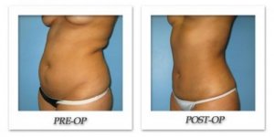 phoca_thumb_l_bruno-liposuction-003