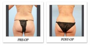 phoca_thumb_l_dr-begovic-liposuction-before-after-001
