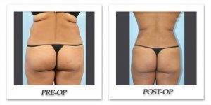 phoca_thumb_l_dr-begovic-liposuction-before-after-003