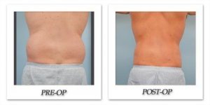 phoca_thumb_l_dr-begovic-liposuction-before-after-004