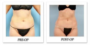 phoca_thumb_l_dr-begovic-liposuction-before-after-008
