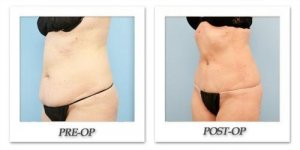 phoca_thumb_l_dr-begovic-liposuction-before-after-009