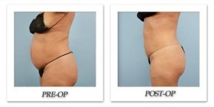 phoca_thumb_l_dr-begovic-liposuction-before-after-010