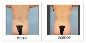 phoca_thumb_l_dr-begovic-liposuction-before-after-012