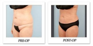 phoca_thumb_l_dr-begovic-liposuction-before-after-013