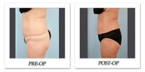 phoca_thumb_l_dr-begovic-liposuction-before-after-014