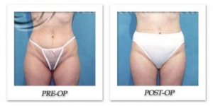 phoca_thumb_l_hodnett-liposuction-002