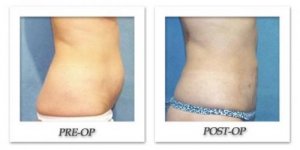 phoca_thumb_l_hodnett-liposuction-003