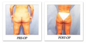 phoca_thumb_l_hodnett-liposuction-004