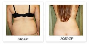 phoca_thumb_l_liposuction-before-after-017