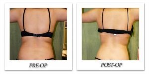 phoca_thumb_l_liposuction-before-after-018