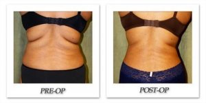 phoca_thumb_l_liposuction-before-after-021