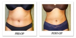 phoca_thumb_l_liposuction-before-after-022