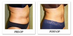 phoca_thumb_l_liposuction-before-after-023