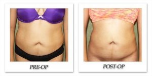 phoca_thumb_l_liposuction-before-after-025