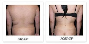 phoca_thumb_l_mandris-liposuction-008