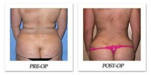 phoca_thumb_l_mandris-liposuction-019
