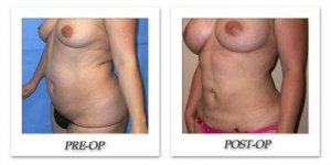 phoca_thumb_l_mandris-liposuction-021