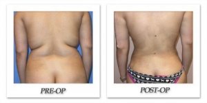 phoca_thumb_l_mandris-liposuction-022