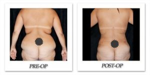 phoca_thumb_l_mandris-liposuction-023
