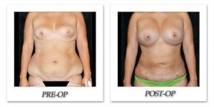phoca_thumb_l_mandris-liposuction-024