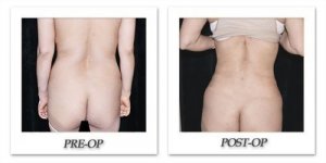 phoca_thumb_l_mandris-liposuction-027