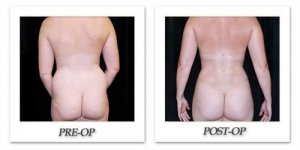 phoca_thumb_l_mandris-liposuction-029