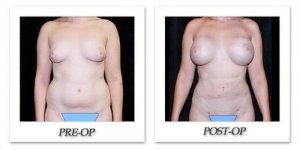 phoca_thumb_l_mandris-liposuction-030