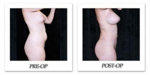 phoca_thumb_l_mandris-liposuction-031