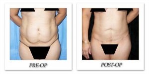 phoca_thumb_l_mandris-liposuction-037