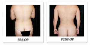 phoca_thumb_l_mandris-liposuction-043