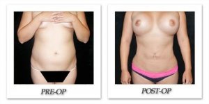 phoca_thumb_l_mandris-liposuction-044
