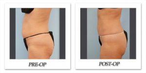 Liposuction