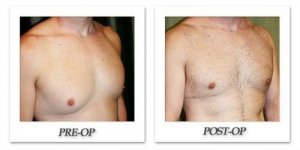 phoca_thumb_l_dr-begovic-male-breast-reduction-before-after-002