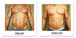 phoca_thumb_l_liposuction-before-after-015