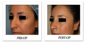 phoca_thumb_m_bruno-rhinoplasty-002