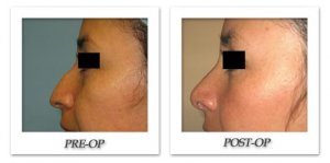 phoca_thumb_m_bruno-rhinoplasty-003