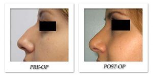 phoca_thumb_m_bruno-rhinoplasty-006