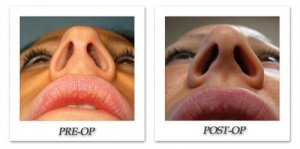 phoca_thumb_m_bruno-rhinoplasty-009