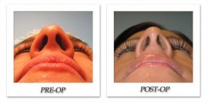 phoca_thumb_m_bruno-rhinoplasty-010