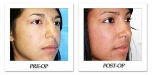phoca_thumb_m_dr-begovic-rhinoplasty-before-after-001-oblique