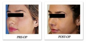 phoca_thumb_m_dr-begovic-rhinoplasty-before-after-002-oblique