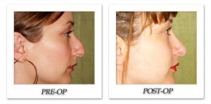 phoca_thumb_m_dr-begovic-rhinoplasty-before-after-003-side